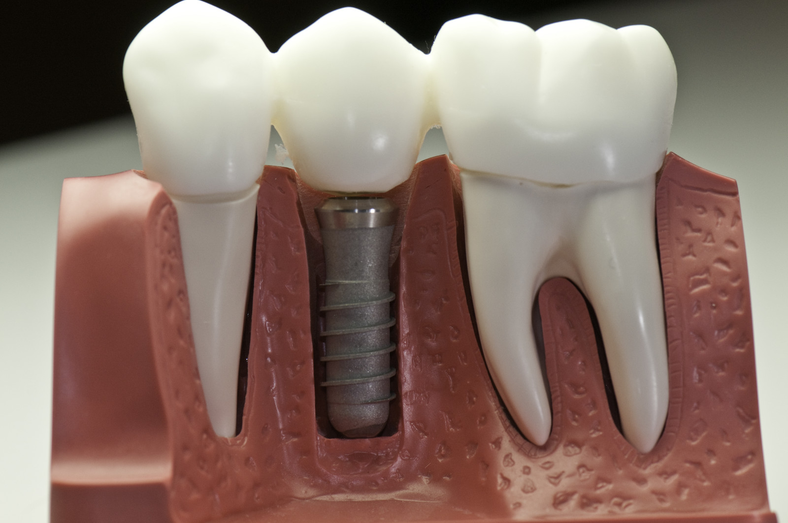 Dental implants in winnipeg