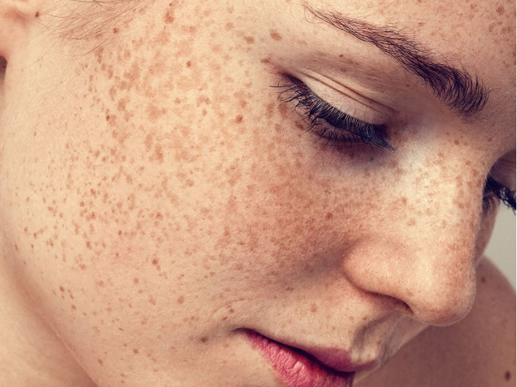Home Remedies for Hyperpigmentation