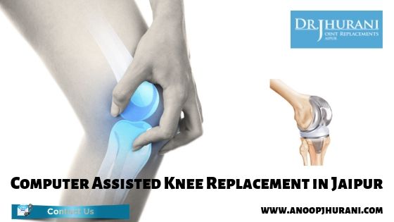 Computer Assisted Knee Replacement in Jaipur