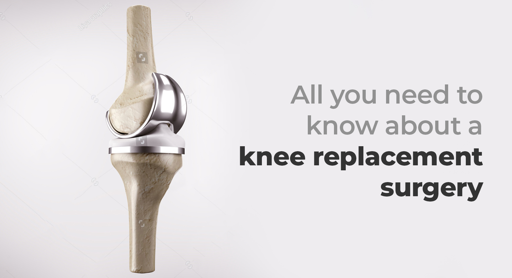 All you need to know about a knee replacement surgery