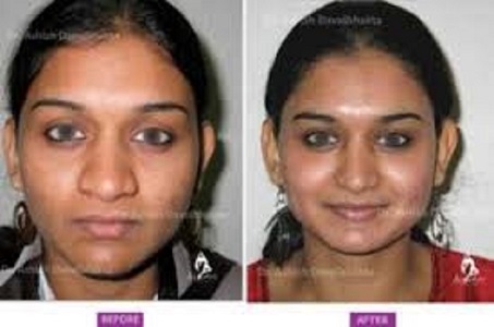 Nose Job Surgeons In Lucknow
