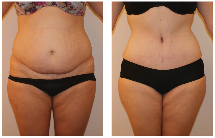 liposuction cost in Punjab