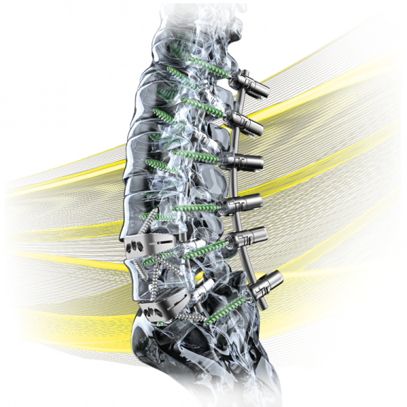 spine implants