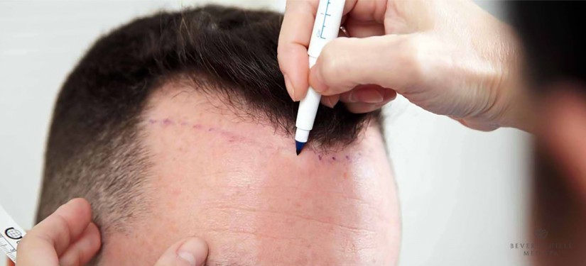 FUE hair transplant