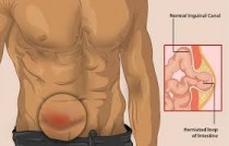 Hernia treatment