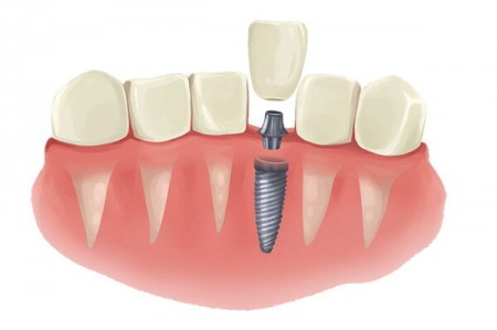 How much do implant teeth cost?