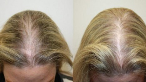 Non-surgical Hair Restoration