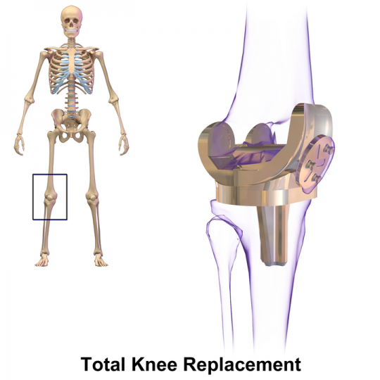 Knee Replacement Surgeons in Delhi