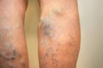 Spider Vein Removal; Learn About The Treatments: