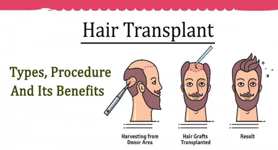 Beverly hills hair restoration- Hair Replacement- Types, Procedure, and Its Benefits