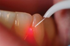 Laser Dental Treatments in Jaipur