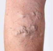 Frequently Asked Questions (FAQ)  About Varicose Veins: