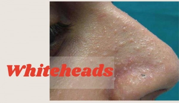 Whiteheads,pimples,
