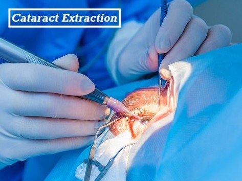 Cataract Extraction