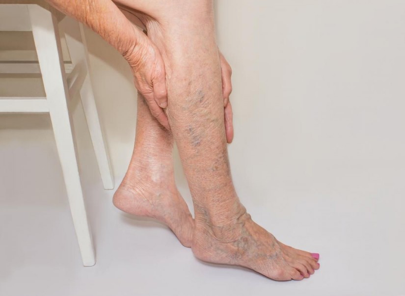 Vein Problems: Causes, Symptoms, Treatment, Diagnosis