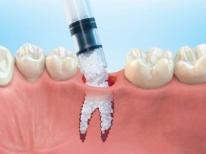 Dental Bone Graft Substitute Market  - TechSci Research