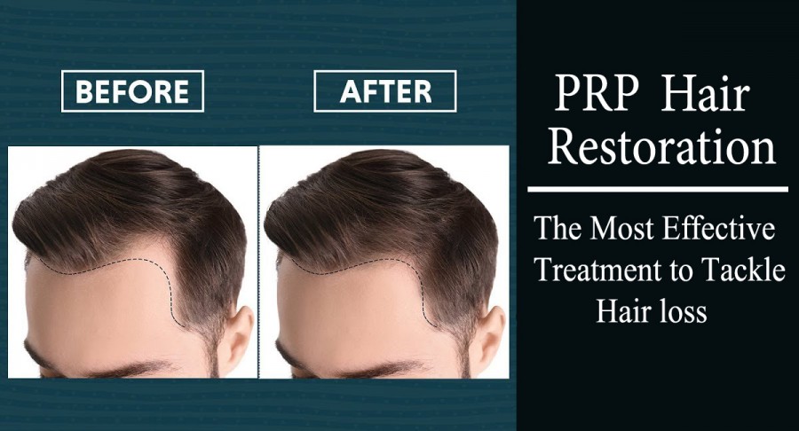 PRP for hair loss- PRP Hair Restoration - The Most Effective Treatment to Tackle Hair loss