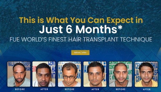 Hair Transplant Ludhiana
