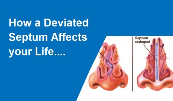 Deviated Septum Affects your Life