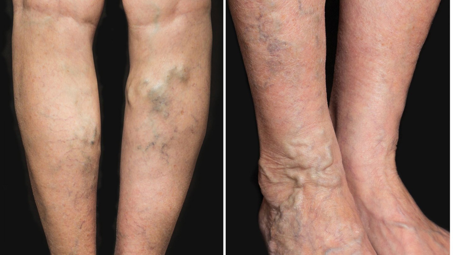 The Great Deal Of Trying The Veins Treatment?