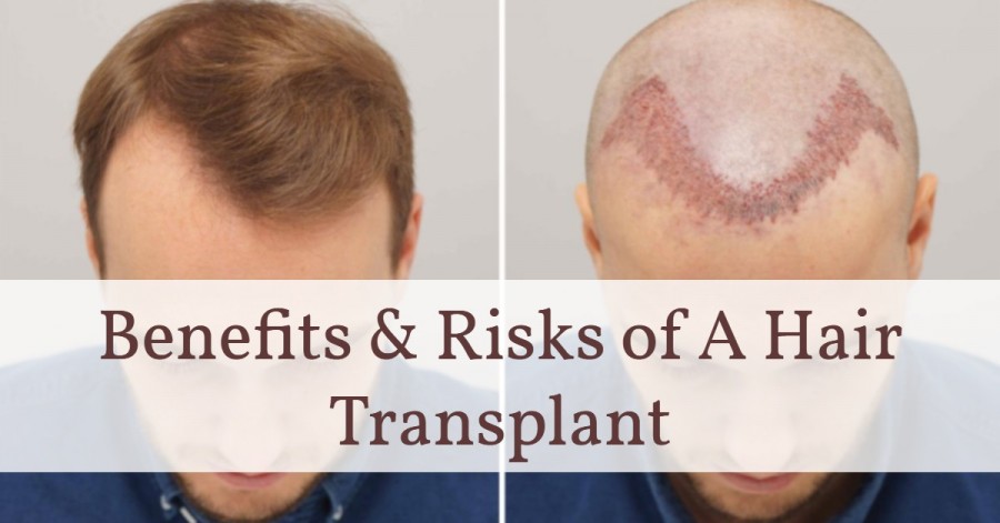 Hair transplant- Benefits & Risks of A Hair Transplant