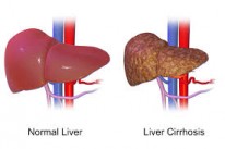 Liver Disease